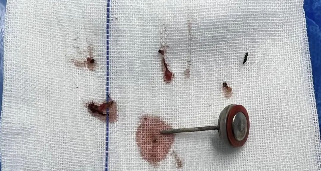 惊险！2岁孩子好奇咬电池，发生爆炸