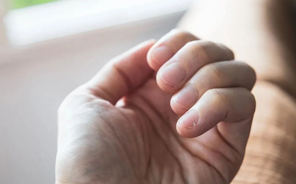 手上长倒刺，千万别直接拔！有人因此进急诊，提醒→