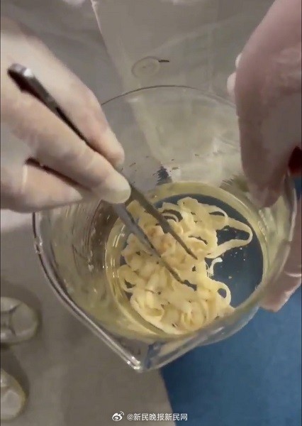 女子体内排出10米长绦虫 原是两年前旅游吃了特色生牛肉中招
