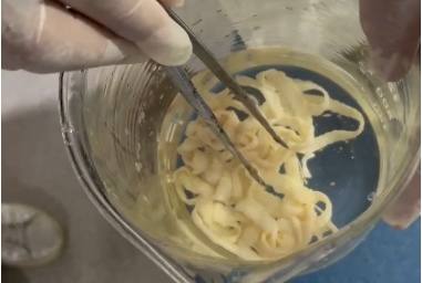 年轻女子体内竟藏10米长虫！医生"揪出"还是活的