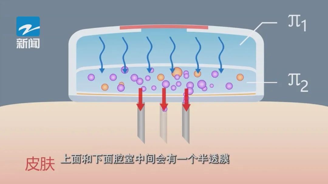 不可思议！挂盐水实现了无痛、“无线”
