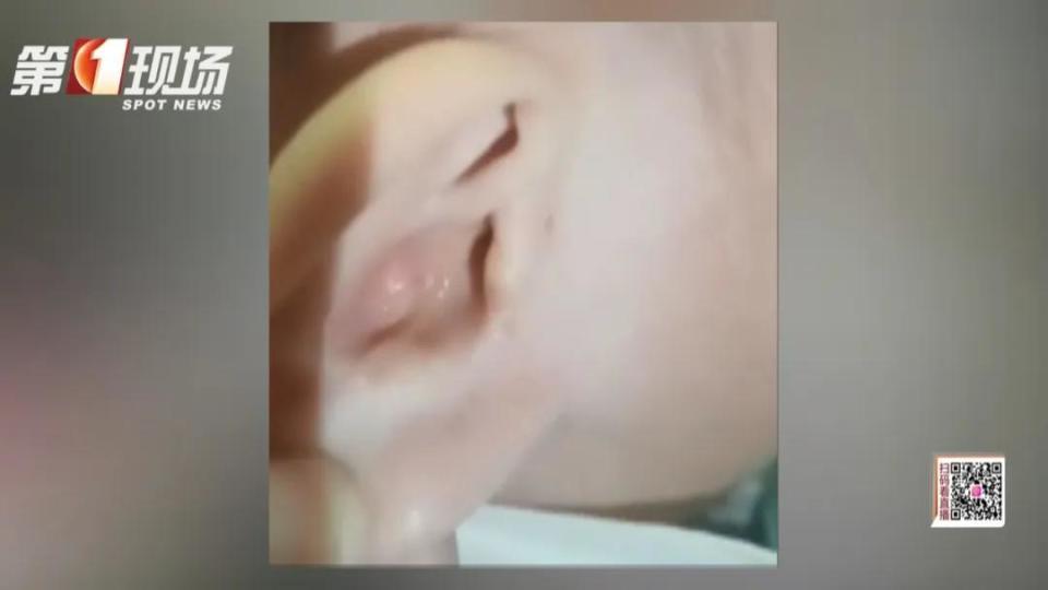 揪心！1岁半宝宝“脑脊液”从耳朵流出，只因模仿大人做了这个动作