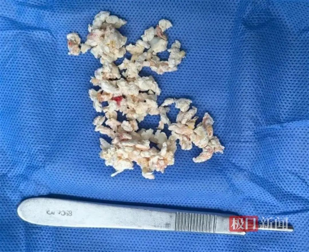 每天喝它,男子膝盖里发现30多颗……疼得无法下地 每天喝它,男子膝盖里发现30多颗……疼得无法下地