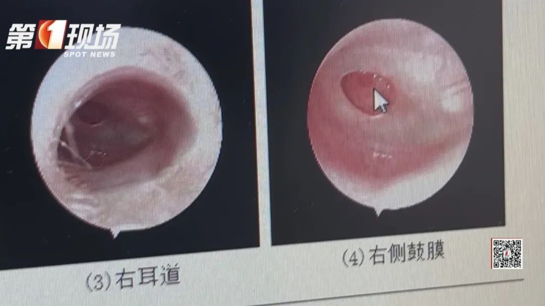 揪心!1岁半宝宝"脑脊液"从耳朵流出,只因模仿大人做了这个动作… 揪心!1岁半宝宝"脑脊液"从耳朵流出,只因模仿大人做了这个动作…