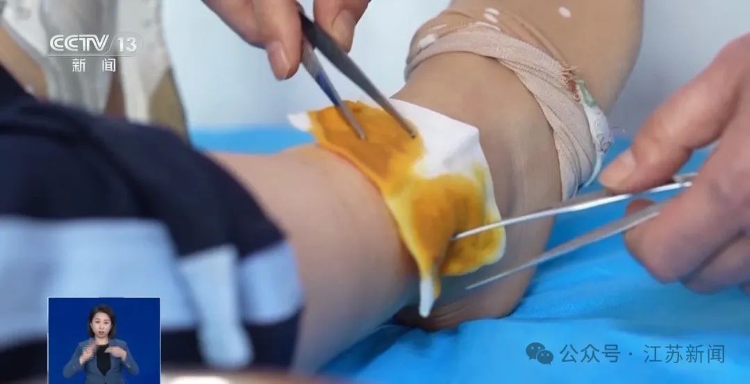 一觉醒来，12岁女儿腿部造成三级烫伤，只因妈妈用了这个……