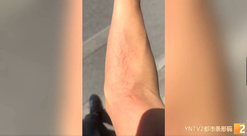 被下病危通知书!手指遭咬后全身起红疹严重过敏,他险些...... 被下病危通知书!手指遭咬后全身起红疹严重过敏,他险些......