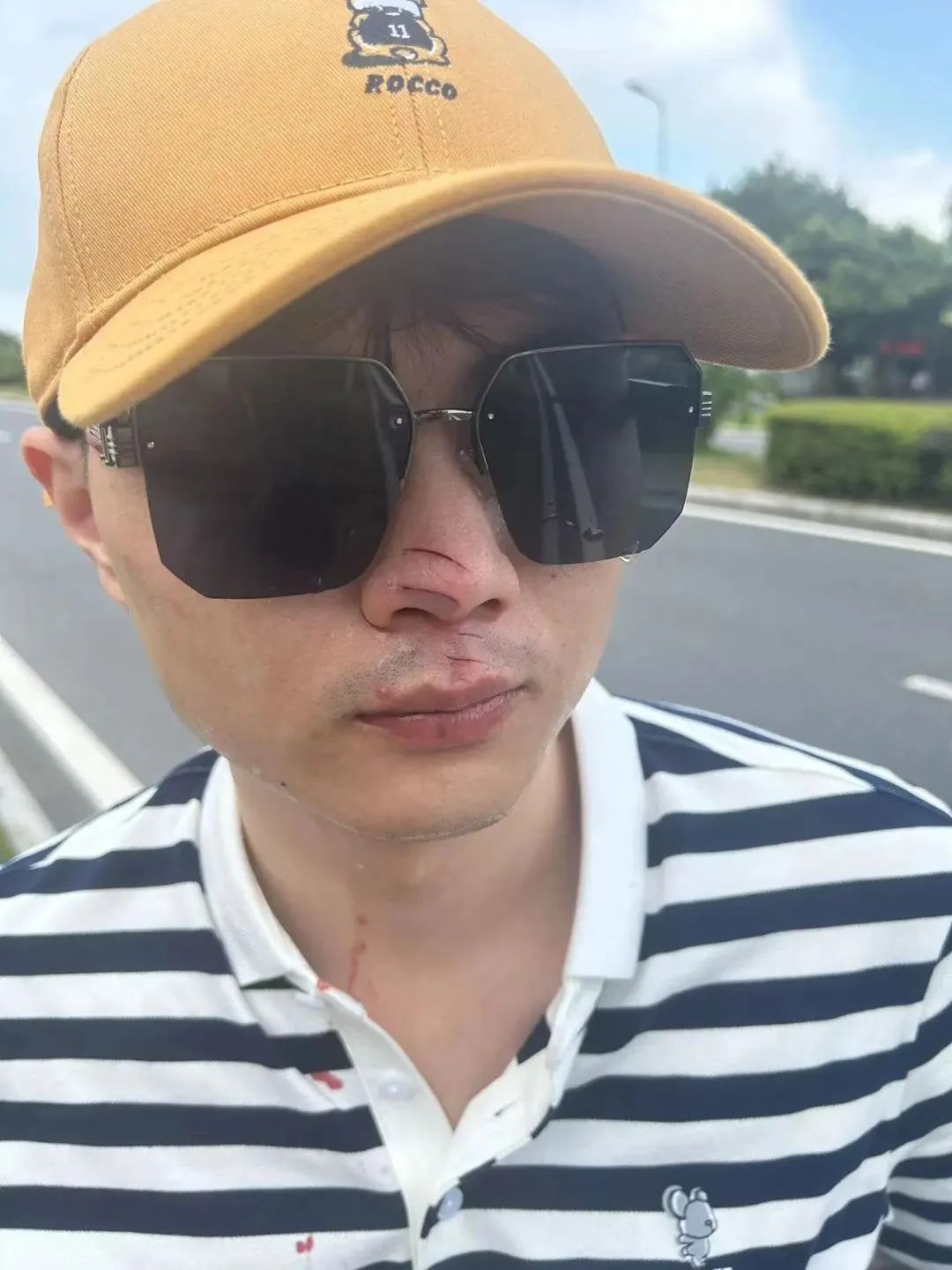 “女子湖边打卡遭无人机撞脸”上热搜！无人机伤人，飞手该担何责？律师解读→