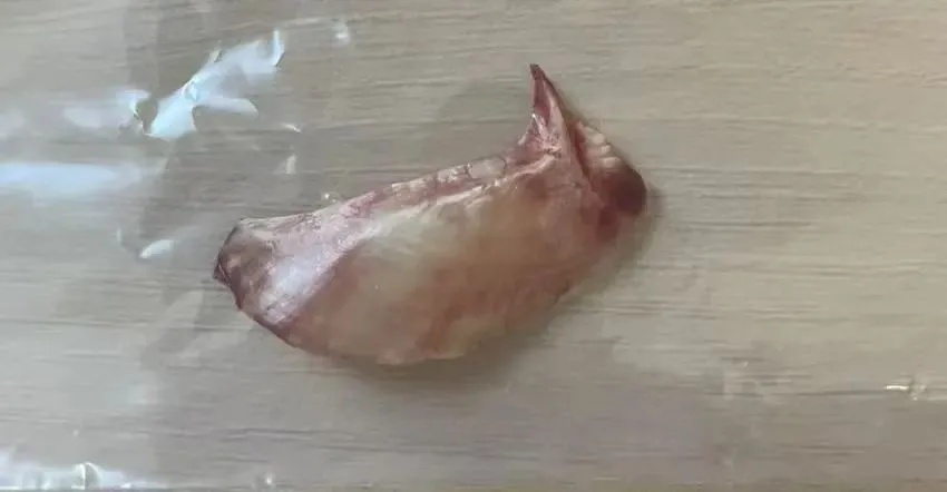 直插心脏!男子吃饭时一个动作险些丧命 处理这件事要当心 直插心脏!男子吃饭时一个动作险些丧命 处理这件事要当心