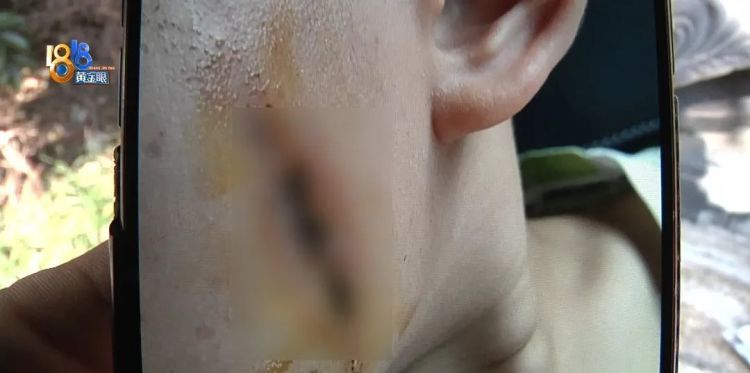 后怕！5岁男童瞬间晕厥，筋都断了……街上常见，看见立即远离