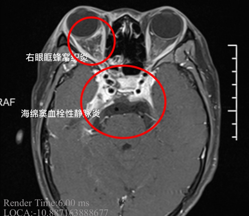 女子一个“小动作”，结果脸上溃烂进了急诊！严重可致死亡…