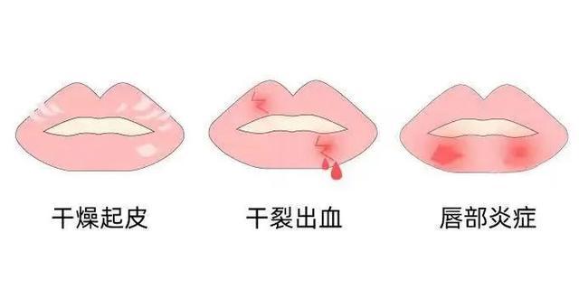 嘴唇干裂原来不是缺水，而是缺这个！