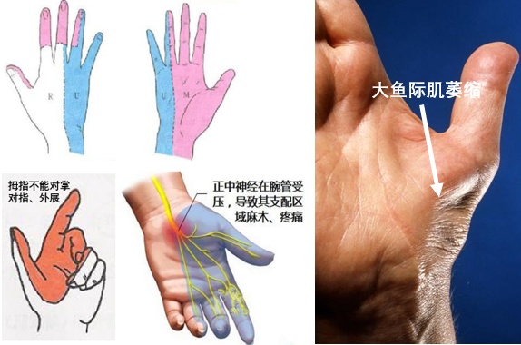 职业病目录有新增！“鼠标手”入列，明年8月1日起实施