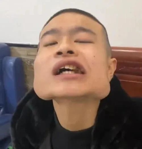 他8年吃掉40多万元！脸变正方形！一级致癌，已致多人割舌、病亡……