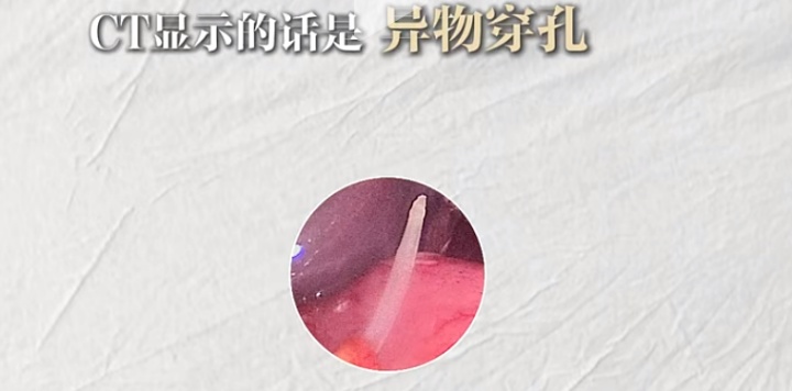 上海知名主持人自曝:被此物穿破胃扎到肝,已紧急手术→ 上海知名主持人自曝:被此物穿破胃扎到肝,已紧急手术→