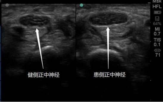 职业病目录有新增！“鼠标手”入列，明年8月1日起实施