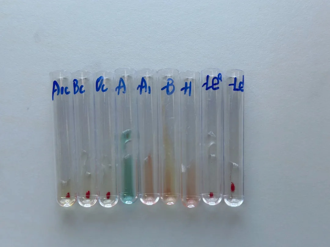 发现一例,极为罕见!医生:这类人早做准备 发现一例,极为罕见!医生:这类人早做准备