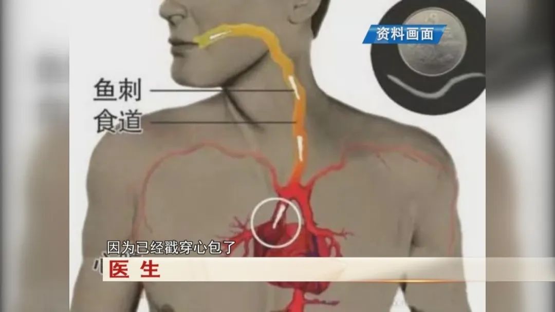 男子吃饭聊天，鱼刺插上心脏！医生提醒！警惕！严重可致命！