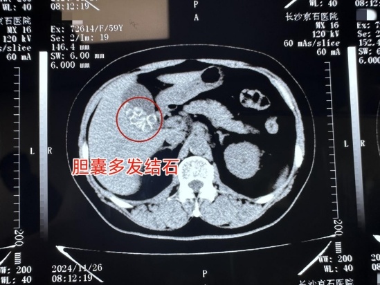 提醒！长期过量食用这类食物，小心被它盯上