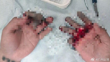 从绝望到“新生”!23岁小伙7根手指离断医生12小时全接回 从绝望到“新生”!23岁小伙7根手指离断医生12小时全接回