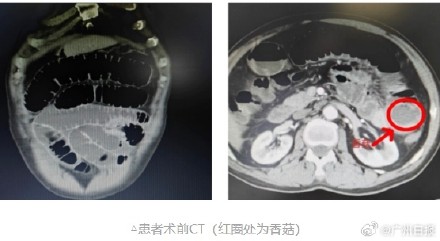 吃饭得专心！男子吞下一颗完整香菇把肠子堵了