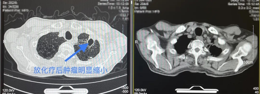 确诊癌症！男子懵了：我只是肩痛……医生：警惕这些信号