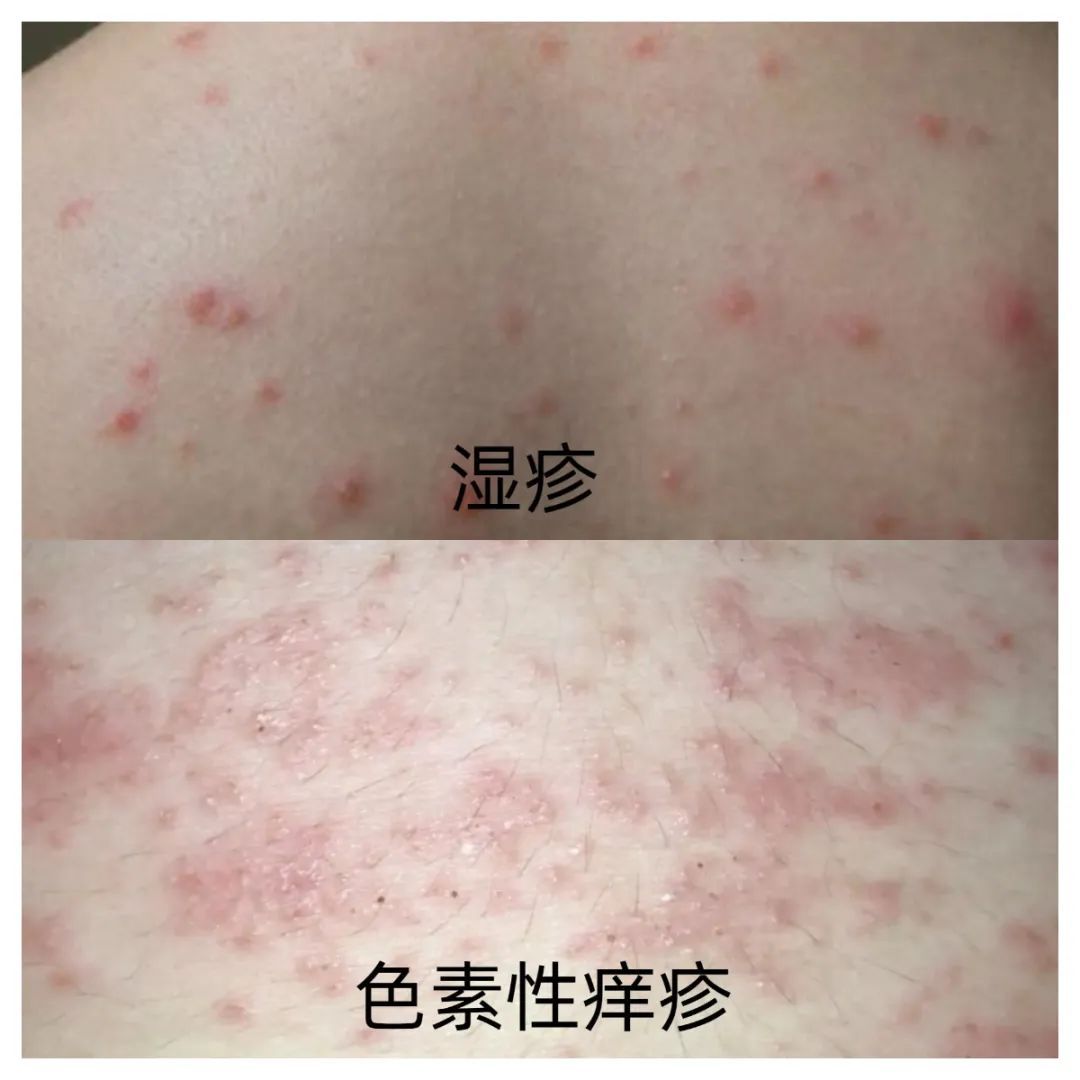 25岁女主播全身脱皮、奇痒不止，确诊了这个病！原因竟是……医生：很少见