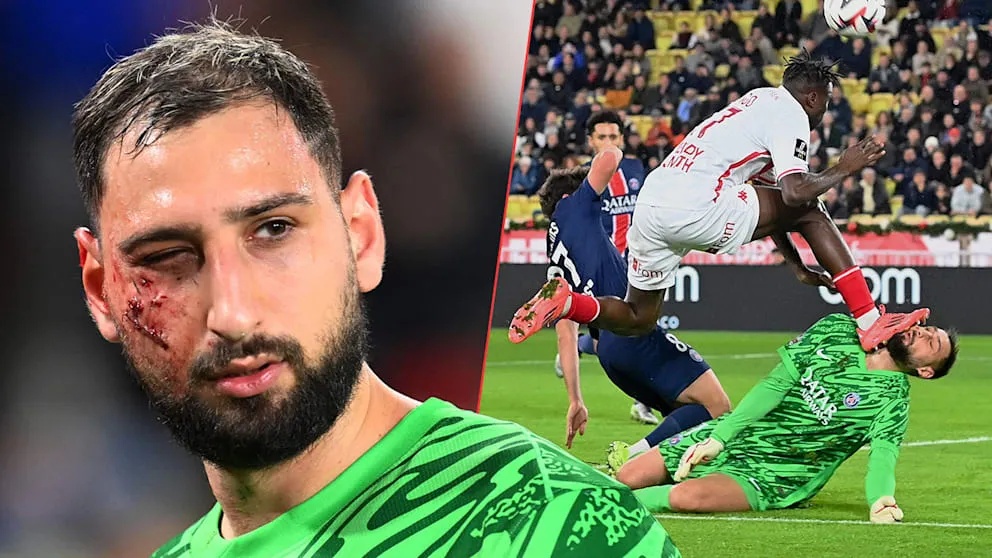 法甲再现恶劣犯规,唐纳鲁马面部遭踩踏缝了10针,施暴者连黄牌都没得! 法甲再现恶劣犯规,唐纳鲁马面部遭踩踏缝了10针,施暴者连黄牌都没得!