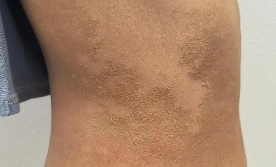 25岁女主播全身脱皮、奇痒不止，确诊了这个病！原因竟是……医生：很少见