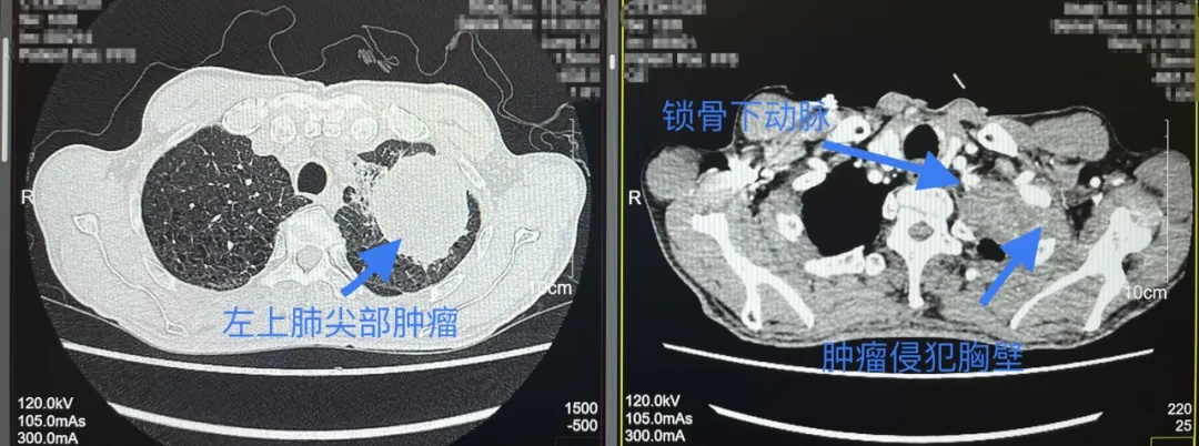 确诊癌症！男子懵了：我只是肩痛……医生：警惕这些信号