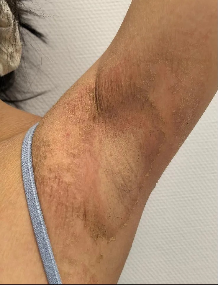 25岁女主播全身脱皮、奇痒不止，确诊了这个病！原因竟是……医生：很少见