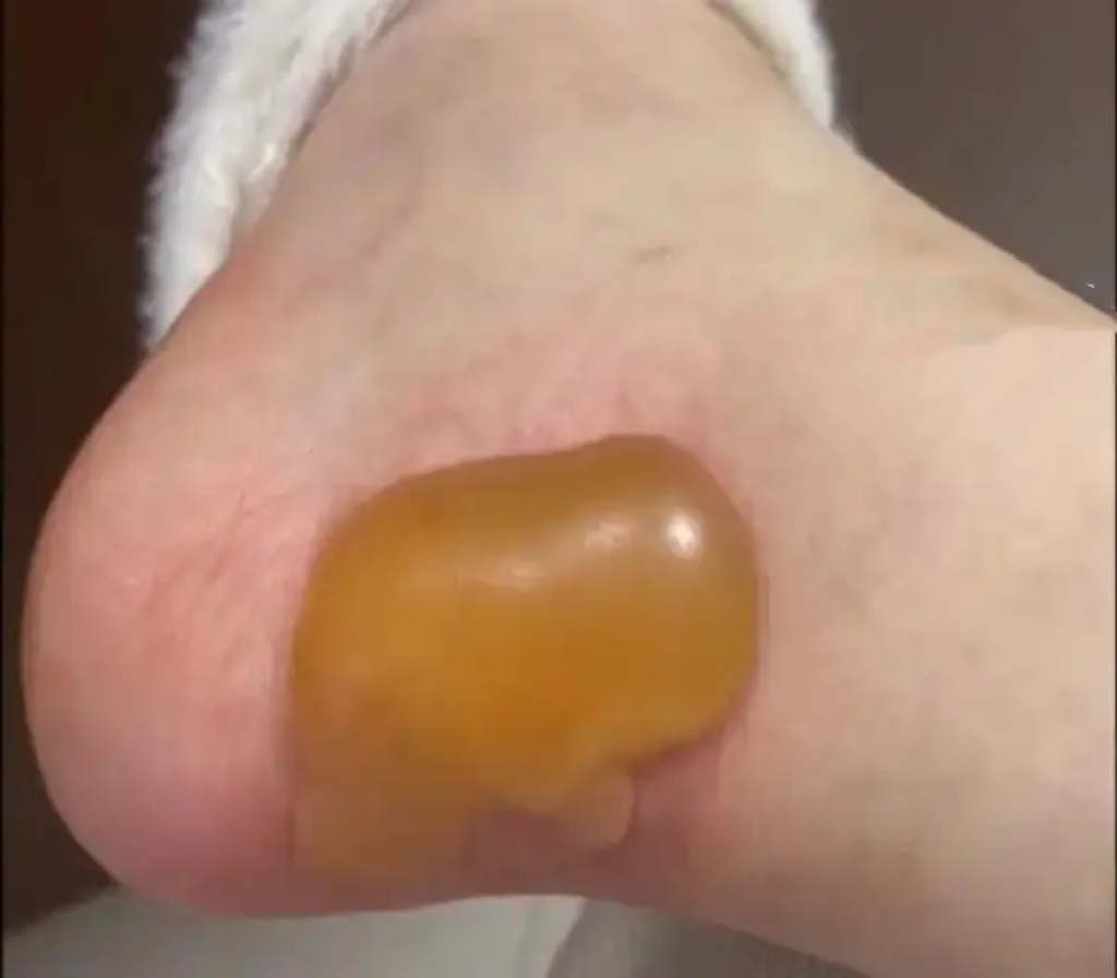 危险️!女子跟风打卡致二级烫伤 危险️!女子跟风打卡致二级烫伤