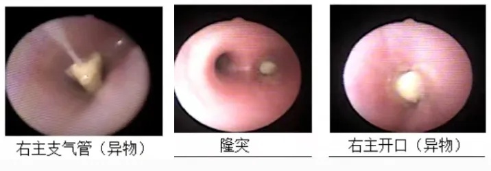 惊险一幕!2岁幼儿被卡 惊险一幕!2岁幼儿被卡