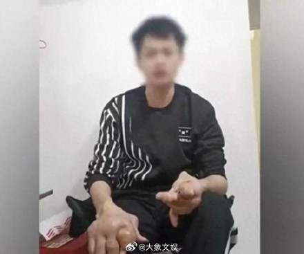 小伙从小爱喝饮料双手长满痛风石 痛风为何盯上年轻人 小伙从小爱喝饮料双手长满痛风石 痛风为何盯上年轻人