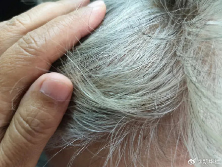 转发!白头发越长越多可能缺这3种营养 转发!白头发越长越多可能缺这3种营养