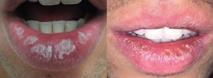 近期上海此类患者增多！有人被反复折磨：从崩溃到摆烂！根本没法见人…