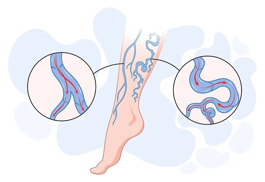 血管堵塞的人“藏不住”,有这6个表现要提高警惕 血管堵塞的人“藏不住”,有这6个表现要提高警惕