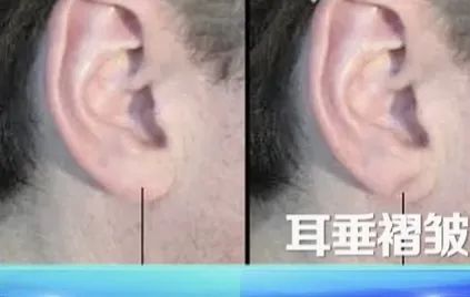 血管堵塞的人“藏不住”,有这6个表现要提高警惕 血管堵塞的人“藏不住”,有这6个表现要提高警惕