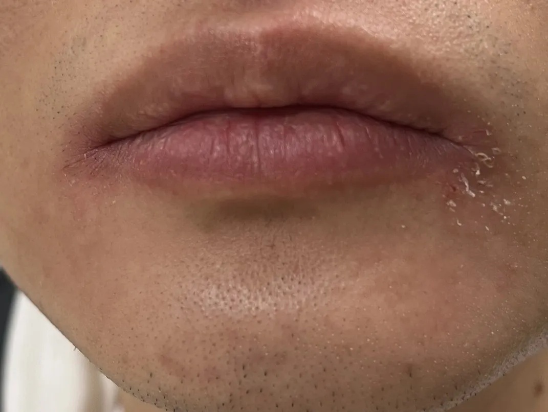 冬季高发,姑娘被它折腾了一年:令人崩溃! 冬季高发,姑娘被它折腾了一年:令人崩溃!