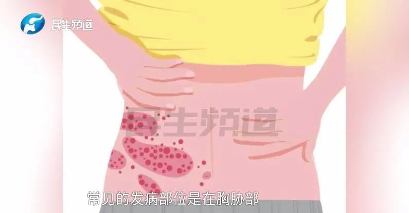 “疼得想哭!半个腰都长满了”,女子确诊......这几类人要小心 “疼得想哭!半个腰都长满了”,女子确诊......这几类人要小心