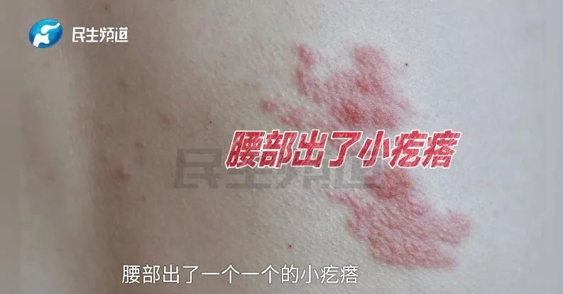“疼得想哭!半个腰都长满了”,女子确诊......这几类人要小心 “疼得想哭!半个腰都长满了”,女子确诊......这几类人要小心