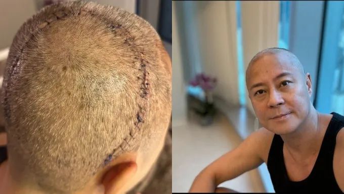 草蜢乐队成员切除脑瘤后首次公开露面