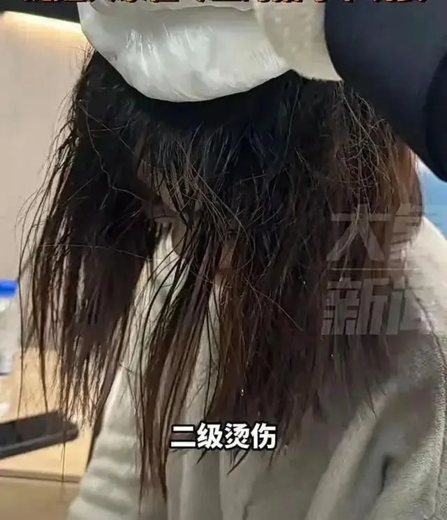 女子头部二级烫伤，冬天这么玩要小心……