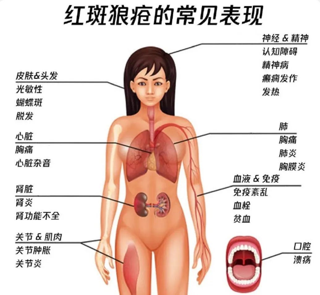 女性发病率约为男性9倍!这种病为何偏爱女性? 女性发病率约为男性9倍!这种病为何偏爱女性?