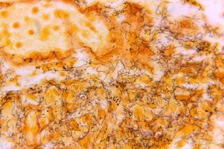 古老DNA显示梅毒源于美洲