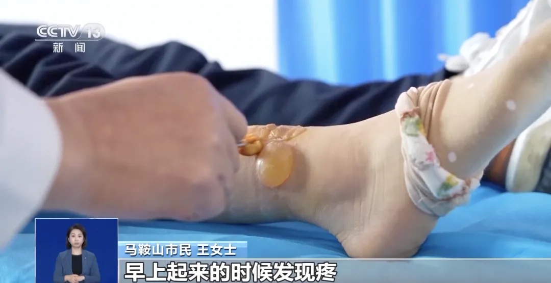 热水袋竟致三级烫伤！谁说温度低就不会烫伤了？