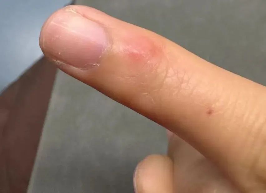 又痛又痒！最近不少人中招：太难受了，千万注意