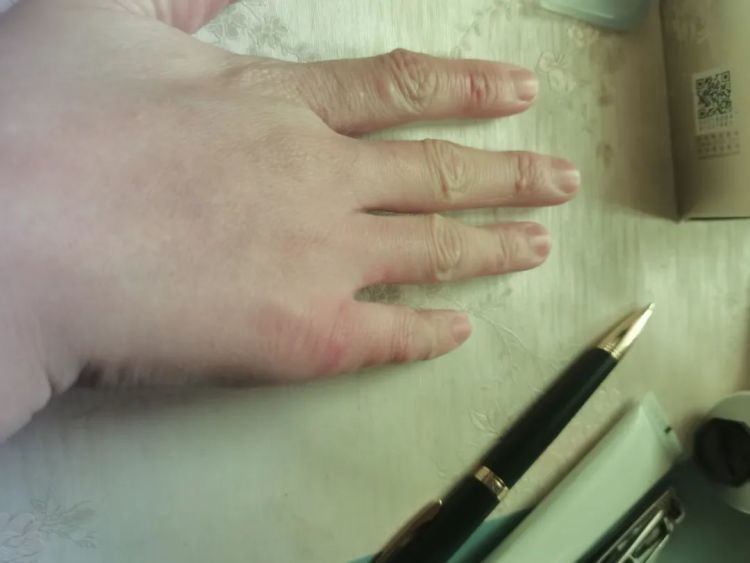 太崩溃!杭州网友:从头到脚长满冻疮,又肿又痒!医生提醒…… 太崩溃!杭州网友:从头到脚长满冻疮,又肿又痒!医生提醒……