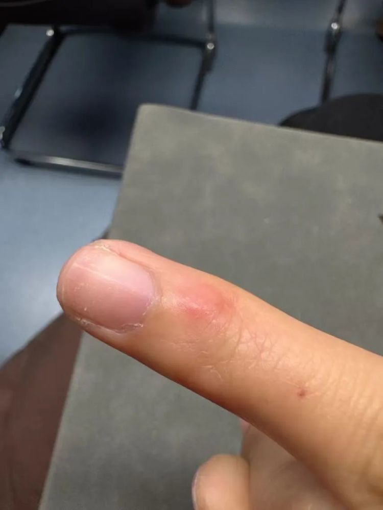 太崩溃!杭州网友:从头到脚长满冻疮,又肿又痒!医生提醒…… 太崩溃!杭州网友:从头到脚长满冻疮,又肿又痒!医生提醒……