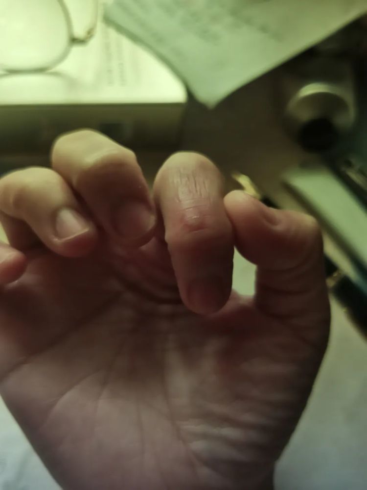 太崩溃!杭州网友:从头到脚长满冻疮,又肿又痒!医生提醒…… 太崩溃!杭州网友:从头到脚长满冻疮,又肿又痒!医生提醒……