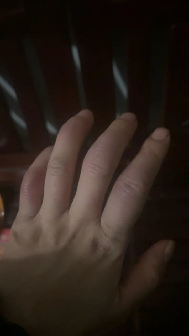 太崩溃!杭州网友:从头到脚长满冻疮,又肿又痒!医生提醒…… 太崩溃!杭州网友:从头到脚长满冻疮,又肿又痒!医生提醒……